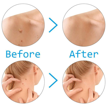 Bőrtagok és szemölcsök eltávolítására szolgáló eszközök készlet — Eredet: Guangzhou; Márka: Skin Tag Removal Tool; Import: Nem