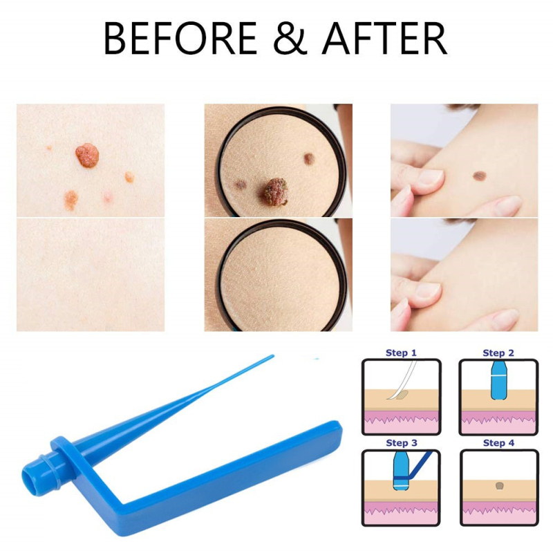 Bőrtagok és szemölcsök eltávolítására szolgáló eszközök készlet — Eredet: Guangzhou; Márka: Skin Tag Removal Tool; Import: Nem