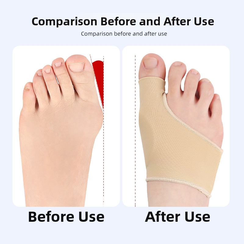 Feet Wake Up Lycra SEBS Protektor Hallux Valgus, Ochranný kryt pre veľký palec a kosti nohy, Denný ochranný kryt na použitie