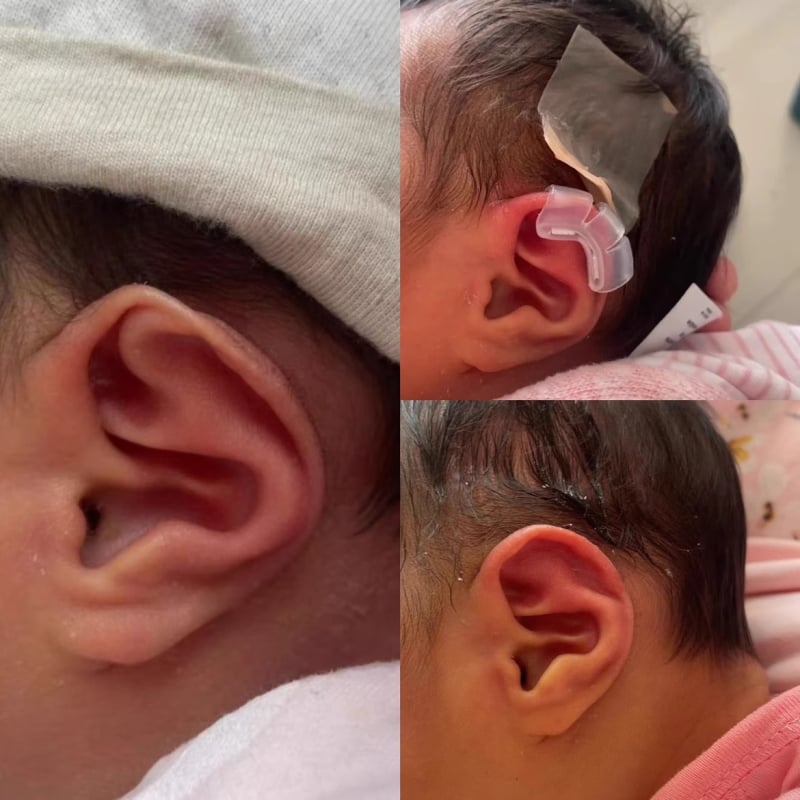 Ушно коригиращо устройство за новородени и възрастни, лепенки за ушна хрущял и поддръжка зад ухото за изпъкнали уши — Color industry; Модел: See description; Време на пазара: See description; Сертификация: Няма