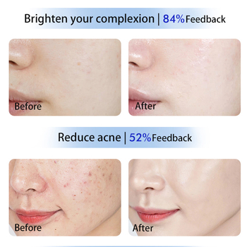 Μάσκα ομορφιάς με φωτοθεραπεία – φως πολυφάσματος για ανάπλαση και λάμψη δέρματος, τροφοδοσία μέσω πρίζας, μοντέλο Lyzm2026, έκδοση 2024