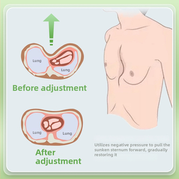 Коректор за фуниеобразен гръден кош с вакуумна чашка — силиконово тяло, модел YKS-4031, марка Medium