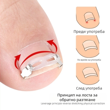 Ортопедично устройство за враснали нокти на краката с тракционен пластир за коригиране на враснали нокти