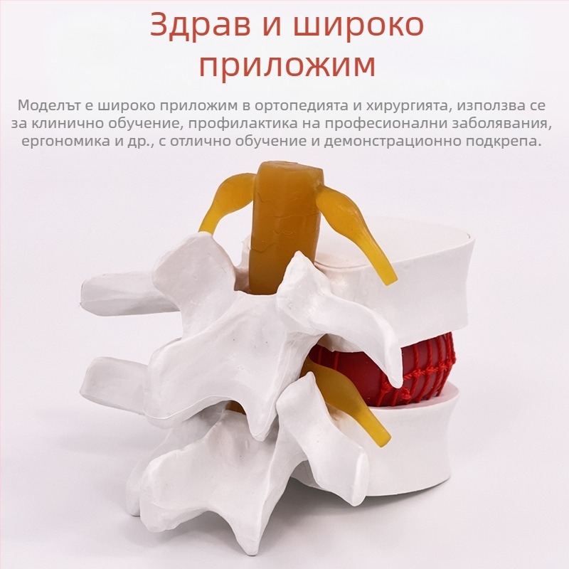 Лумбален модел за медицинско обучение – демонстрация на компресия на лумбалния диск и патология на костите на гръбначния стълб.