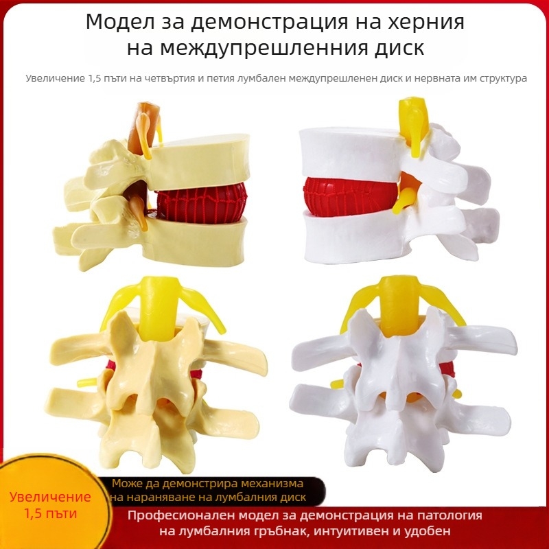 Модел на междупрешленния диск, PVC учебен анатомичен модел за демонстрация на патология на лумбалния гръбнак, Zhenghe River