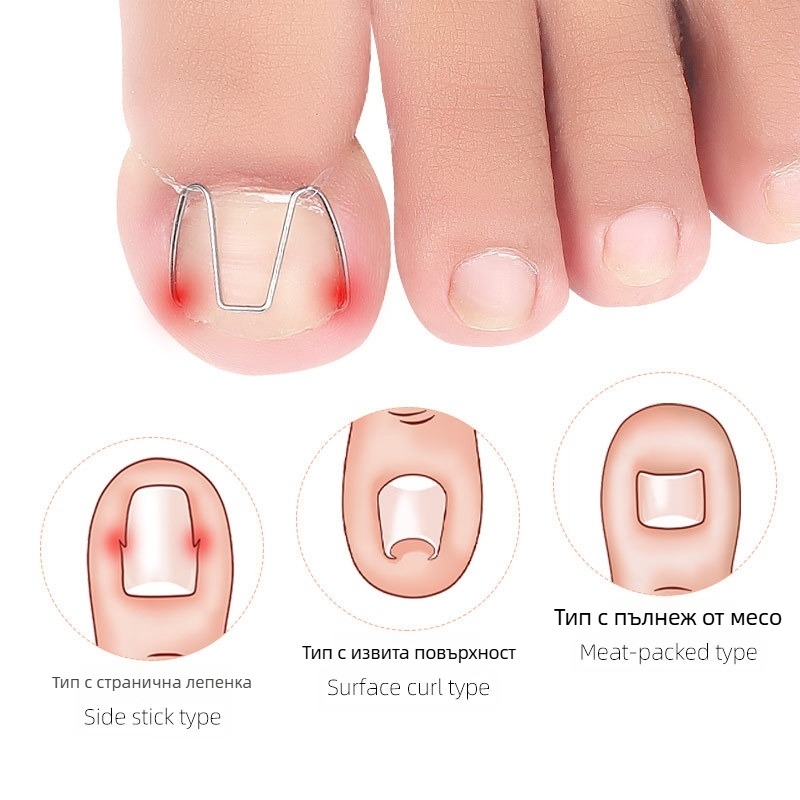 Ортеза за врастнал нокът на пръста; материал: пластмаса + неръждаема стомана; нето съдържание: 12.3; опаковка: 1000 бр; марка: Feet wake up