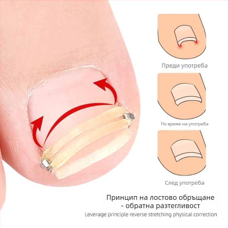 Пръстен за крак за нокти с разтягащ се механизъм и ролка за канала на нокътя; миещ се, повторно използваем, 18 g гума и неръждаема стомана