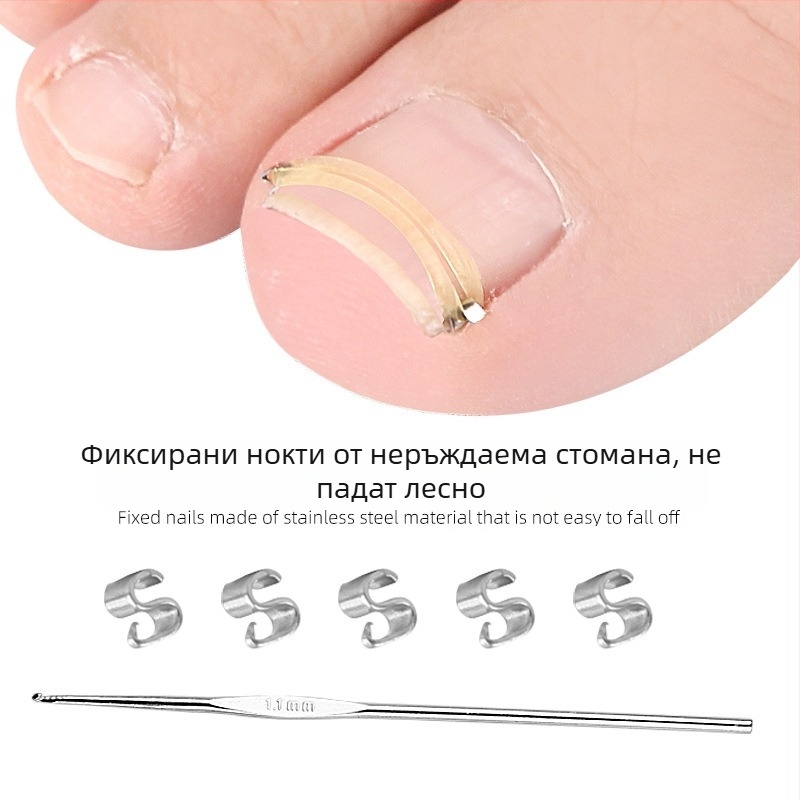 Пръстен за крак за нокти с разтягащ се механизъм и ролка за канала на нокътя; миещ се, повторно използваем, 18 g гума и неръждаема стомана