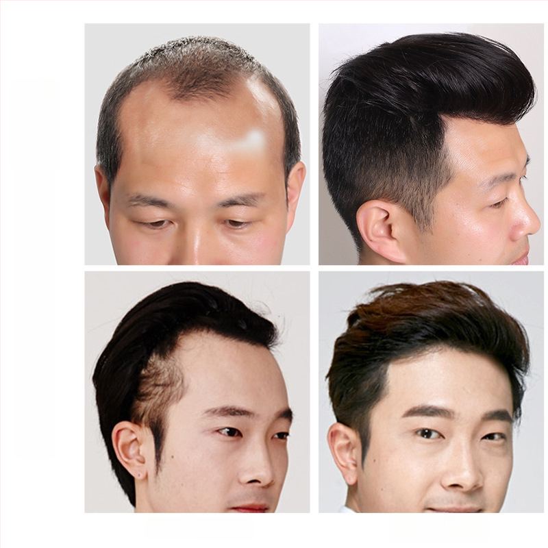 Férfi hajrész a homloknál, láthatatlan hajvonal, valós hajból készült teteje, rövid hossz, kézzel szőtt