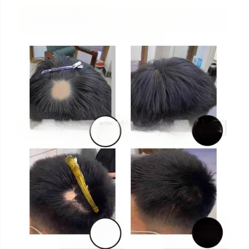 Biológiai fejbőr hegplaszt patch – emberi haj, kézzel szőtt, festhető