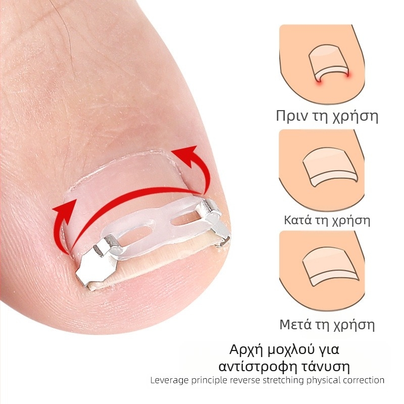Ορθοπεδική συσκευή για όνυχα νύχια με έμπλαστρο έλξης για τη διόρθωση όνυχων νυχιών