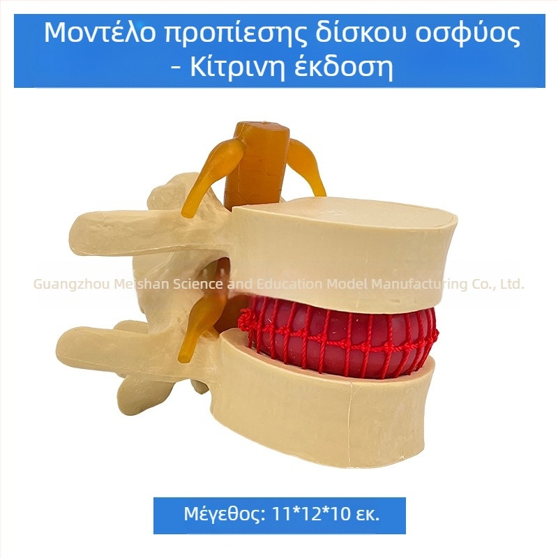 Μοντέλο οσφυϊκής σπονδυλικής στήλης για ιατρική εκπαίδευση – επίδειξη συμπίεσης δίσκου οσφυϊκής περιοχής και παθολογία των οστών της σπονδυλικής στήλης.