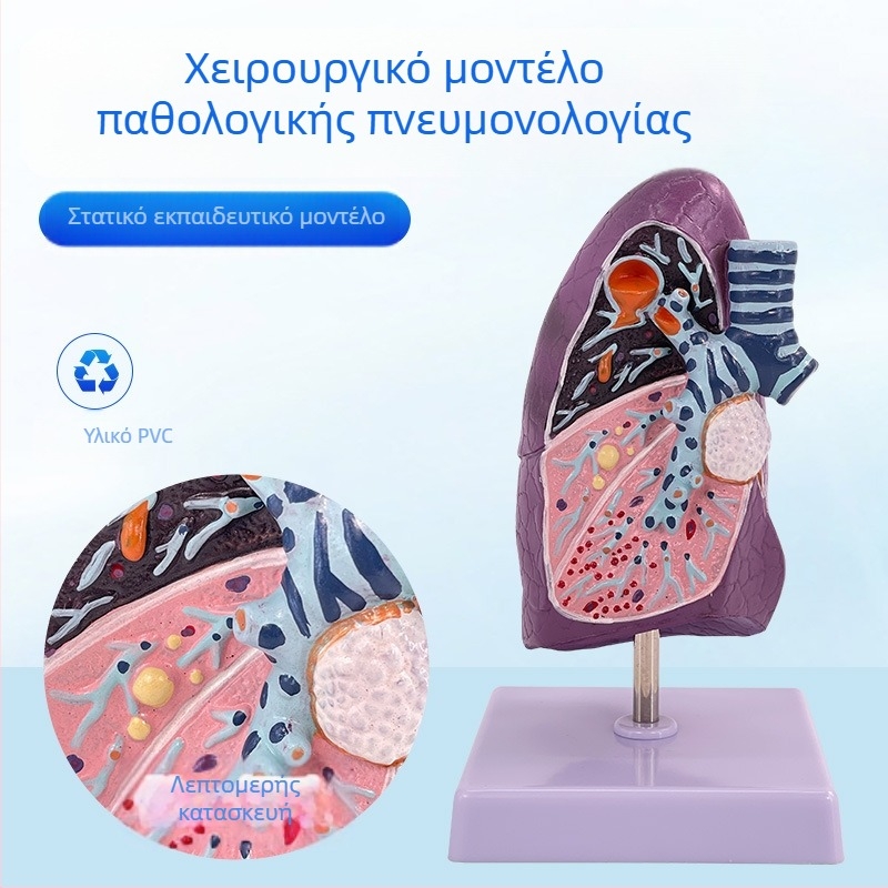 Blue Butterfly πλαστικό μοντέλο εσωτερικών οργάνων: τραχεία και πνεύμονες - ανατομία με παθολογία και διατομή καπνιστικού πνεύμονα.
