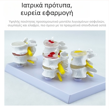Blue Butterfly PVC τετρατμημένο μοντέλο οσφυϊκής σπονδυλικής στήλης: φυσιολογικοί και παθολογικοί σπόνδυλοι με παθολογία δίσκου