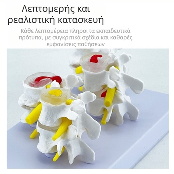 Blue Butterfly PVC τετρατμημένο μοντέλο οσφυϊκής σπονδυλικής στήλης: φυσιολογικοί και παθολογικοί σπόνδυλοι με παθολογία δίσκου