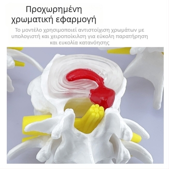 Blue Butterfly PVC τετρατμημένο μοντέλο οσφυϊκής σπονδυλικής στήλης: φυσιολογικοί και παθολογικοί σπόνδυλοι με παθολογία δίσκου