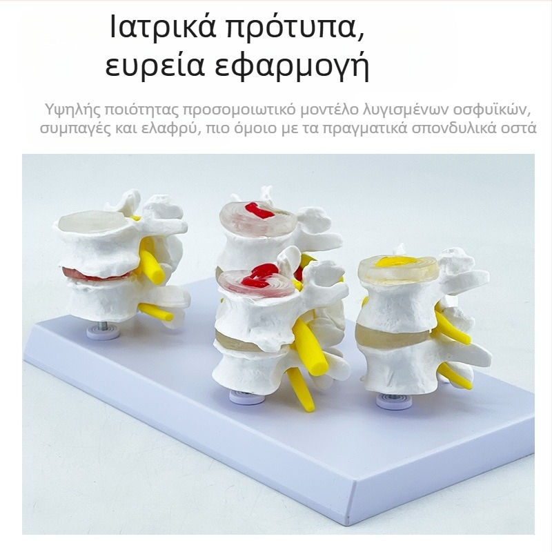 Blue Butterfly PVC τετρατμημένο μοντέλο οσφυϊκής σπονδυλικής στήλης: φυσιολογικοί και παθολογικοί σπόνδυλοι με παθολογία δίσκου