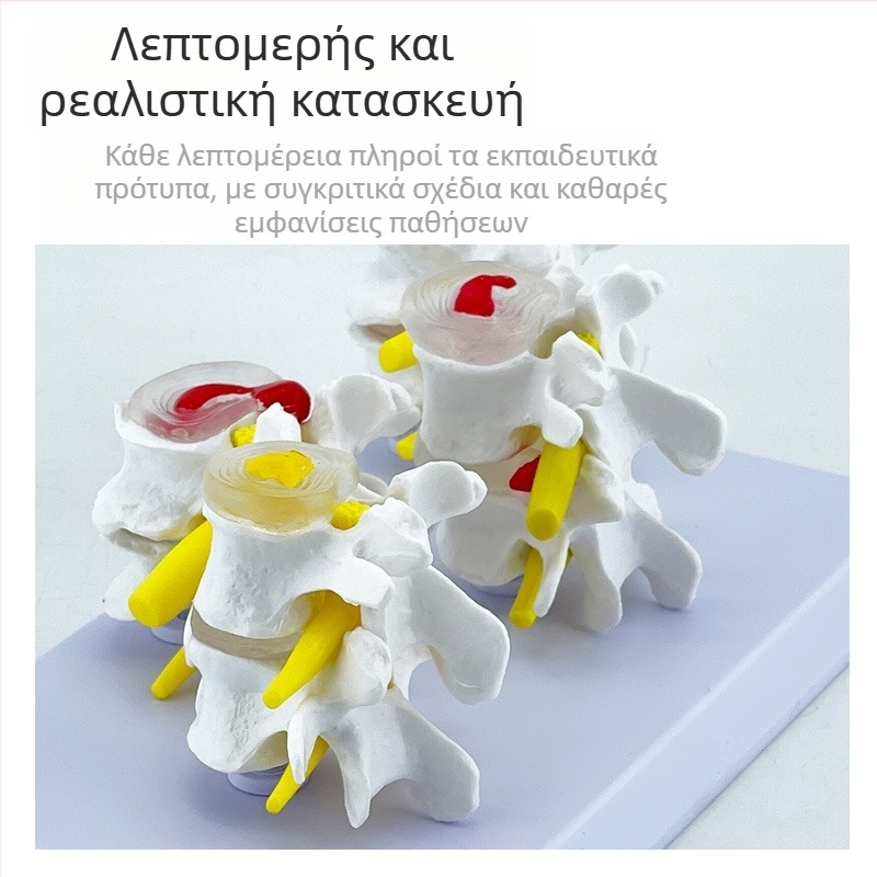 Blue Butterfly PVC τετρατμημένο μοντέλο οσφυϊκής σπονδυλικής στήλης: φυσιολογικοί και παθολογικοί σπόνδυλοι με παθολογία δίσκου
