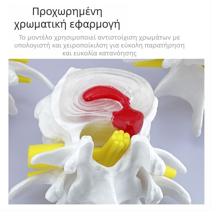 Blue Butterfly PVC τετρατμημένο μοντέλο οσφυϊκής σπονδυλικής στήλης: φυσιολογικοί και παθολογικοί σπόνδυλοι με παθολογία δίσκου