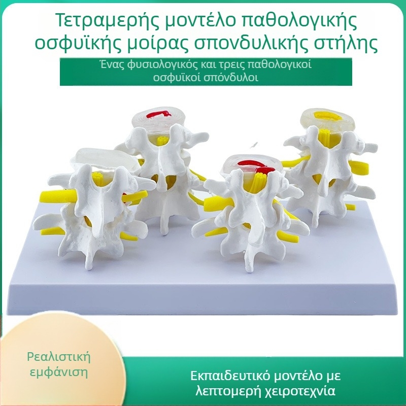 Blue Butterfly PVC τετρατμημένο μοντέλο οσφυϊκής σπονδυλικής στήλης: φυσιολογικοί και παθολογικοί σπόνδυλοι με παθολογία δίσκου