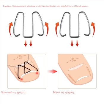 Ορθωτικό νυχιού για ingrown nail; υλικό: πλαστικό + ανοξείδωτο ατσάλι; περιεκτικότητα: 12.3; συσκευασία: 1000 τεμάχια; μάρκα: Feet wake up