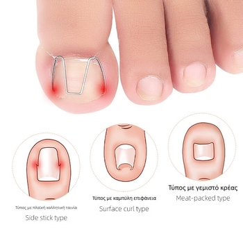 Ορθωτικό νυχιού για ingrown nail; υλικό: πλαστικό + ανοξείδωτο ατσάλι; περιεκτικότητα: 12.3; συσκευασία: 1000 τεμάχια; μάρκα: Feet wake up