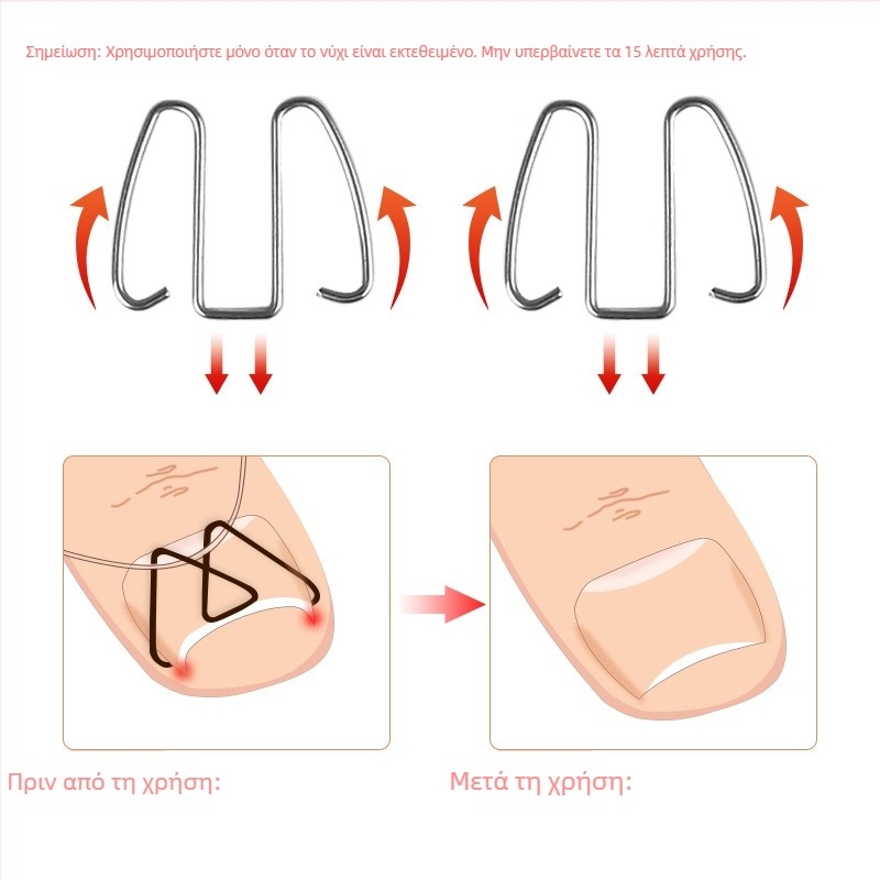 Ορθωτικό νυχιού για ingrown nail; υλικό: πλαστικό + ανοξείδωτο ατσάλι; περιεκτικότητα: 12.3; συσκευασία: 1000 τεμάχια; μάρκα: Feet wake up
