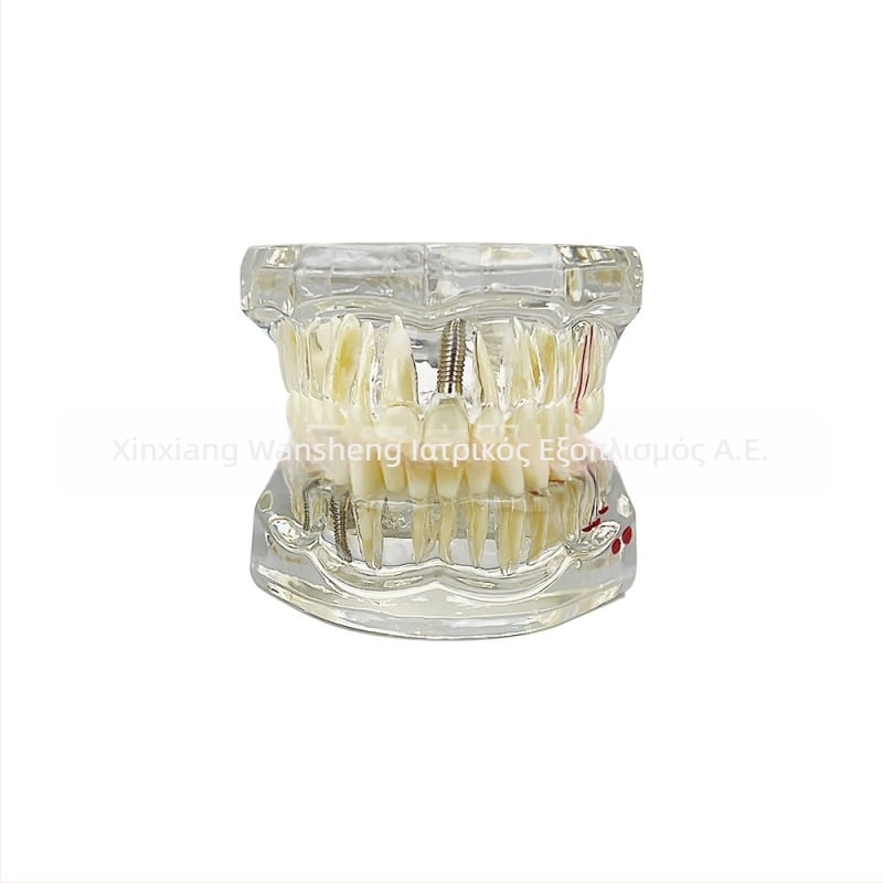 Οδοντιατρικό μοντέλο με παθολογικό στοιχείο, μοντέλο γέφυρας και εμφυτεύματος, αποσπώμενο, κατάλληλο για ενήλικες