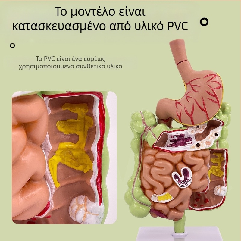 Μοντέλο ανατομίας ανθρώπινου στομάχου — κορωνική τομή, παθολογικό μοντέλο στομάχου με διάτρηση, εκπαίδευση γαστροεντερολογίας