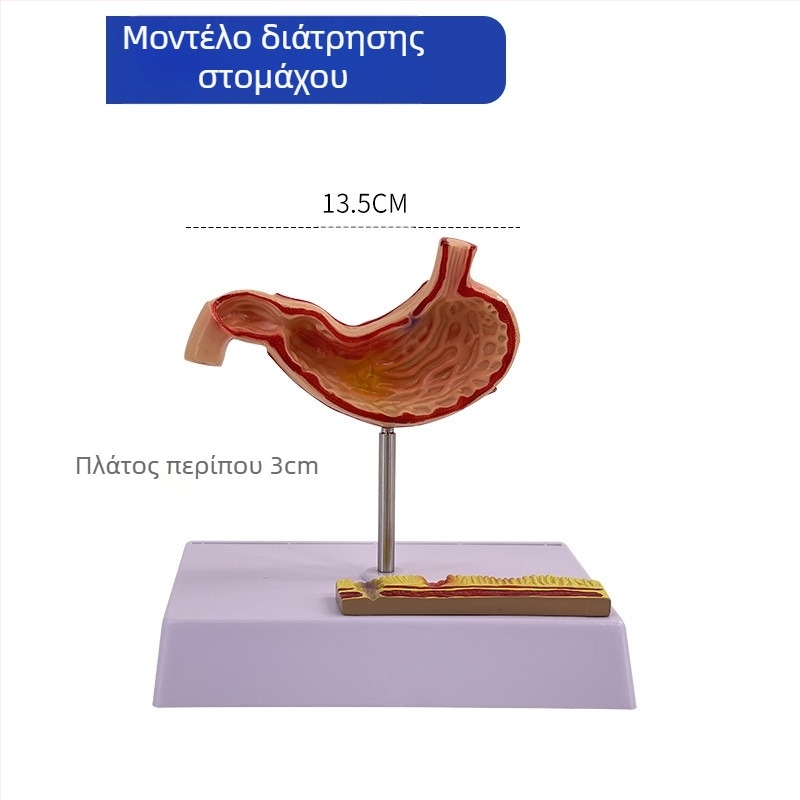 Μοντέλο ανατομίας ανθρώπινου στομάχου — κορωνική τομή, παθολογικό μοντέλο στομάχου με διάτρηση, εκπαίδευση γαστροεντερολογίας