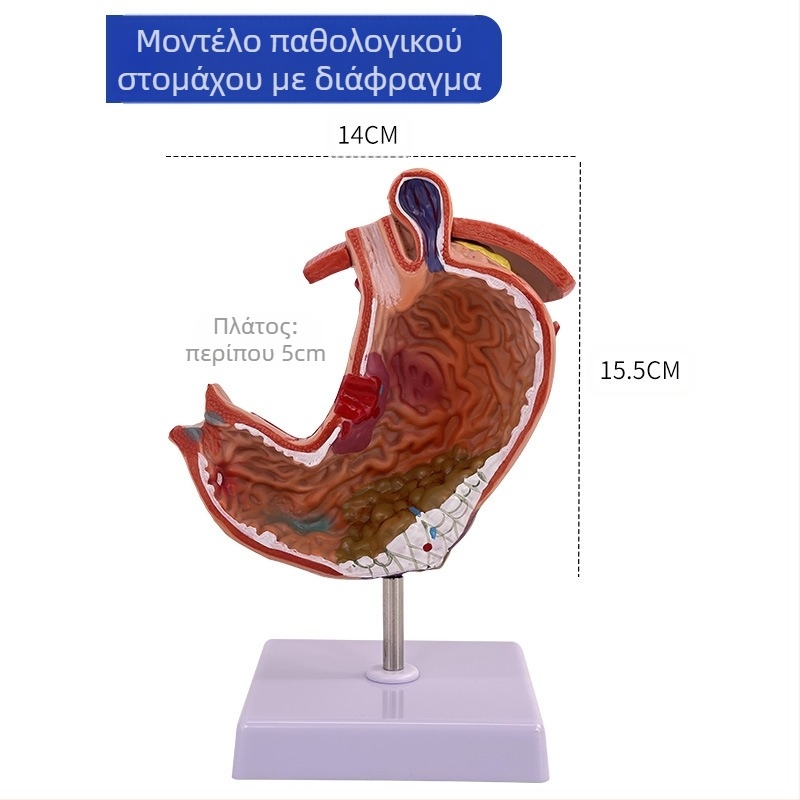 Μοντέλο ανατομίας ανθρώπινου στομάχου — κορωνική τομή, παθολογικό μοντέλο στομάχου με διάτρηση, εκπαίδευση γαστροεντερολογίας