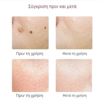 Dot Pen για αφαίρεση κηλίδων και σπίλων – φορητό με ενσωματωμένη μπαταρία 1200–2000mAh, IPX0, Κατηγορία Dot Pen