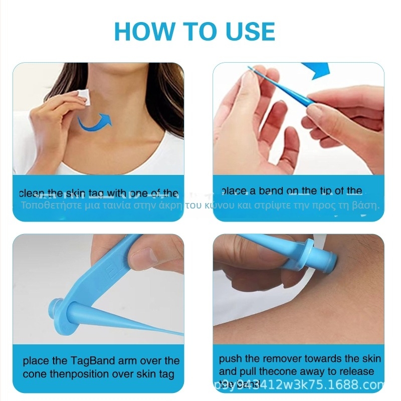 Πένα Αφαίρεσης Κονδυλωμάτων και Ετικετών Δέρματος - Προέλευση Γκουανγκντόνγκ, Περιεχόμενο 50, Συσκευασία 200 τεμάχια, Διάρκεια ζωής 3 έτη