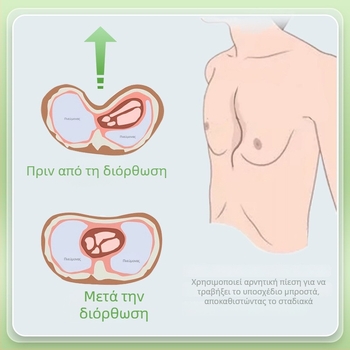 Διορθωτής φουνοειδούς στέρνου με κενού — Σιλικόνη σώματος, Μοντέλο YKS-4031, Μάρκα Medium