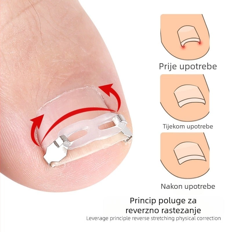 Ortopedski uređaj za urasle nokte s trakcijskim flasterom za korekciju uraslih noktiju