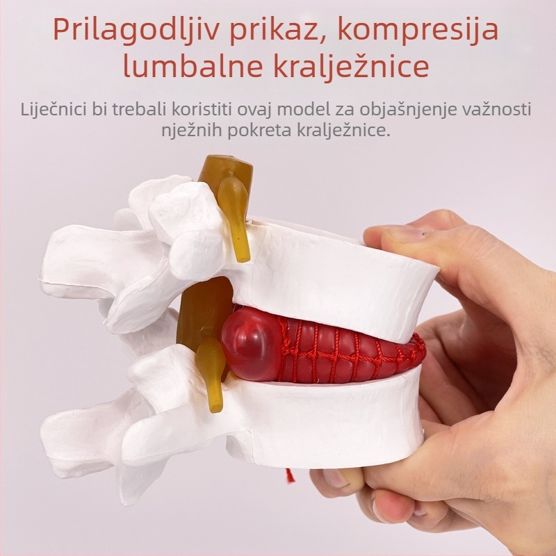 Model lumbalne kralježnice za medicinsku edukaciju – demonstracija kompresije diska i patoloških promjena kostiju kralježnice.