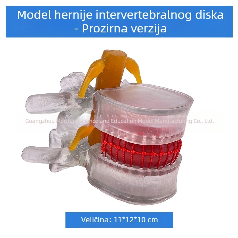 Model lumbalne kralježnice za medicinsku edukaciju – demonstracija kompresije diska i patoloških promjena kostiju kralježnice.