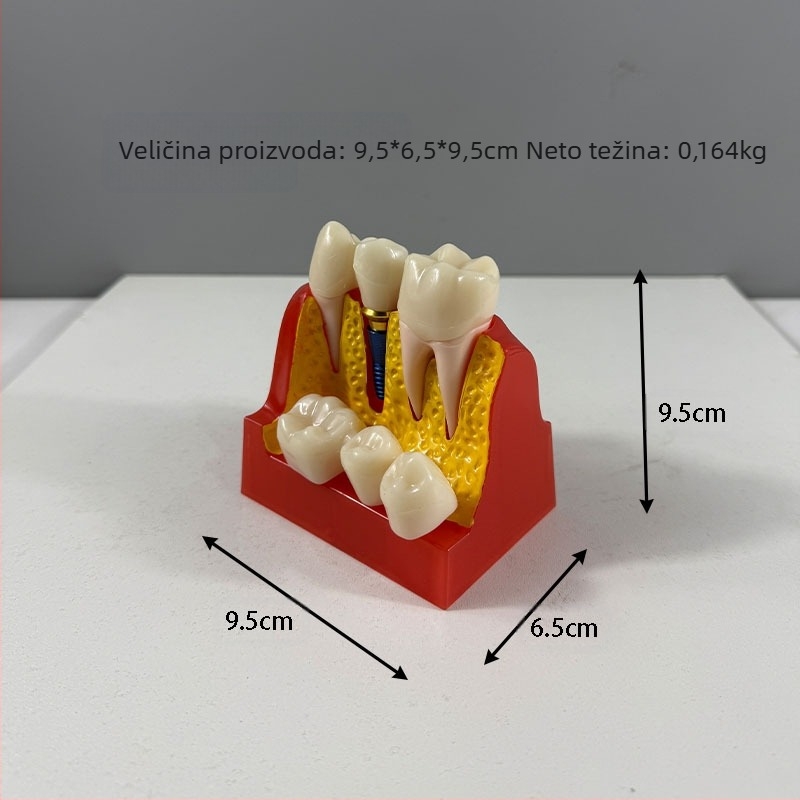 Dentalni model za nastavu studentima s prikazom implantacijskih vijaka, materijal od smole, brend Liyue; podržava privatne marke