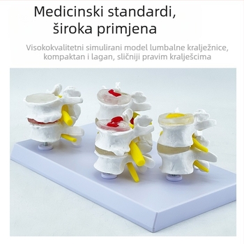Blue Butterfly PVC četverosekleni model lumbalne kralježnice: normalni i patološki kralješci s patološkom diskom