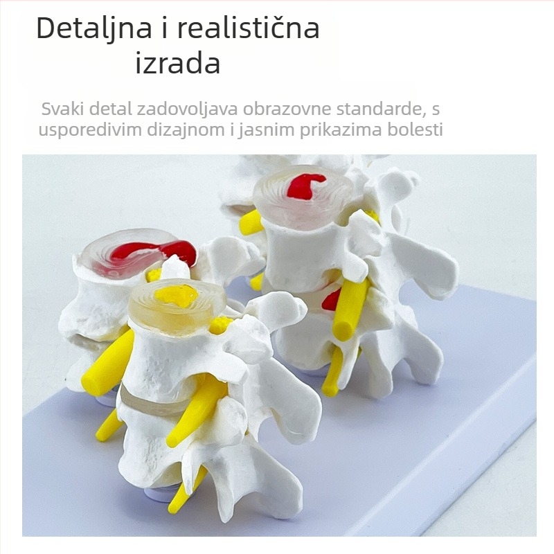 Blue Butterfly PVC četverosekleni model lumbalne kralježnice: normalni i patološki kralješci s patološkom diskom