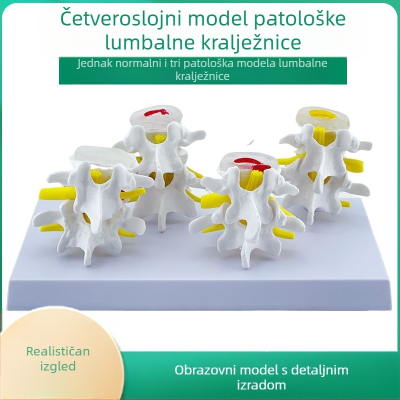 Blue Butterfly PVC četverosekleni model lumbalne kralježnice: normalni i patološki kralješci s patološkom diskom