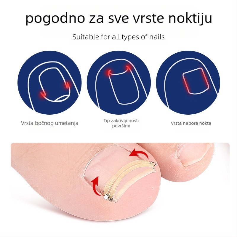 Prsten za nokat na prstu noge s mehanizmom za rastezanje i valjkom za zglob nokta; perivi, ponovo upotrebljivo, 18 g
