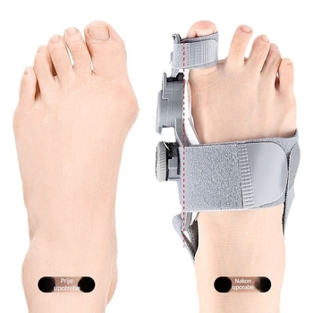 Ispravljač prsta na nozi – Razdjelnik prstiju; Materijali: ABS, najlon i silikon; Model: Ispravljač prsta; Serija: Razdjelnik; Stil: Hallux valgus, personalizirani dizajn; Reverzibilna korekcija.