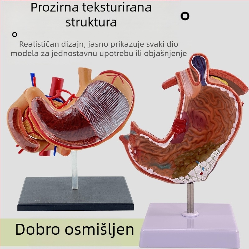 Model ljudskog želuca za anatomiju — koronarni presjek, patološki model želuca s perforacijom, edukacija iz gastroenterologije