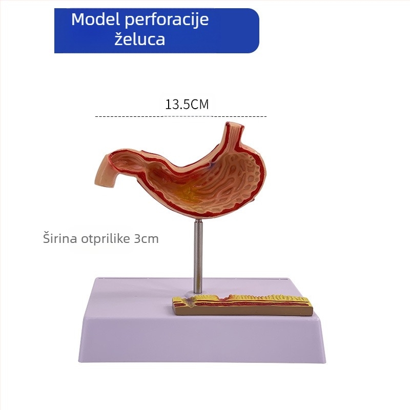 Model ljudskog želuca za anatomiju — koronarni presjek, patološki model želuca s perforacijom, edukacija iz gastroenterologije