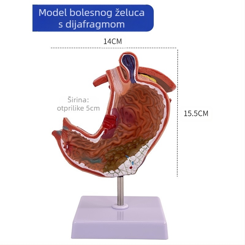 Model ljudskog želuca za anatomiju — koronarni presjek, patološki model želuca s perforacijom, edukacija iz gastroenterologije