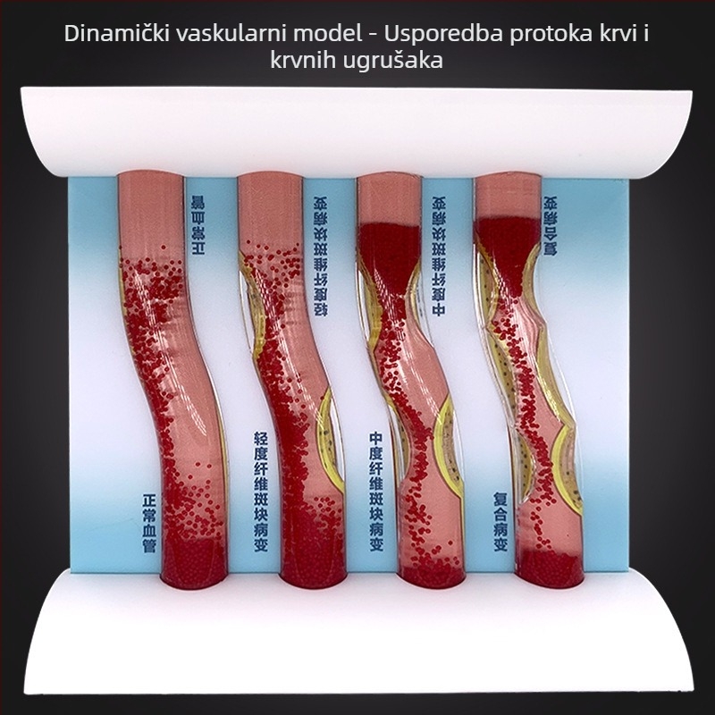 Dinamički vaskularni model od plastike s visoko gustoćnim začepljenjem i trombom plakova – nastavnički model