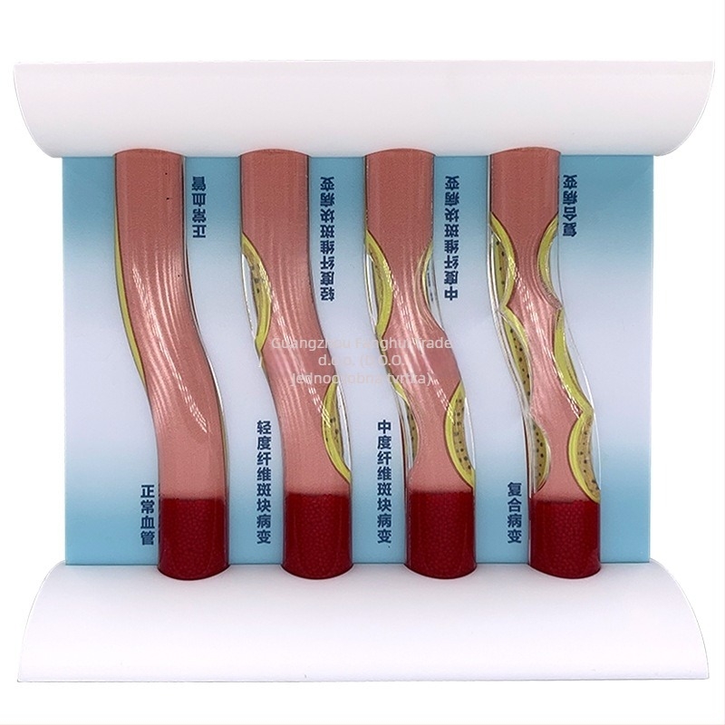 Dinamički vaskularni model od plastike s visoko gustoćnim začepljenjem i trombom plakova – nastavnički model