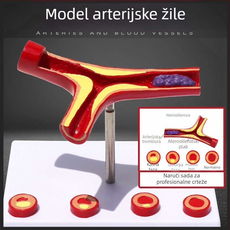 Dinamički vaskularni model od plastike s visoko gustoćnim začepljenjem i trombom plakova – nastavnički model