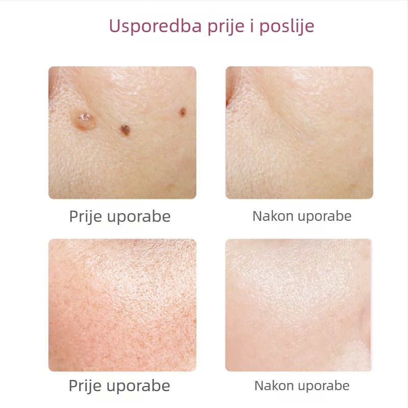 Pero za uklanjanje madeža i pjega – za salon i kućnu upotrebu – laserski uređaj za uklanjanje pjega